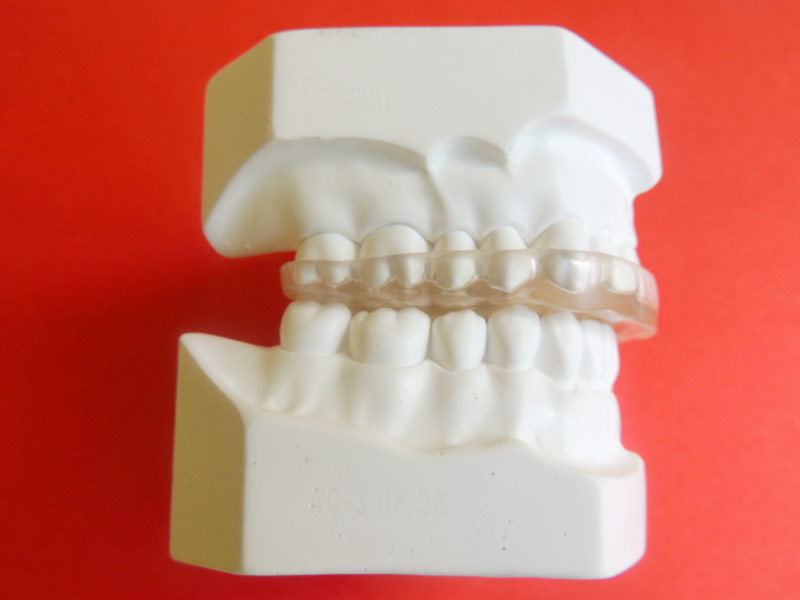Clínica Dental Bejerano - Férula de descarga