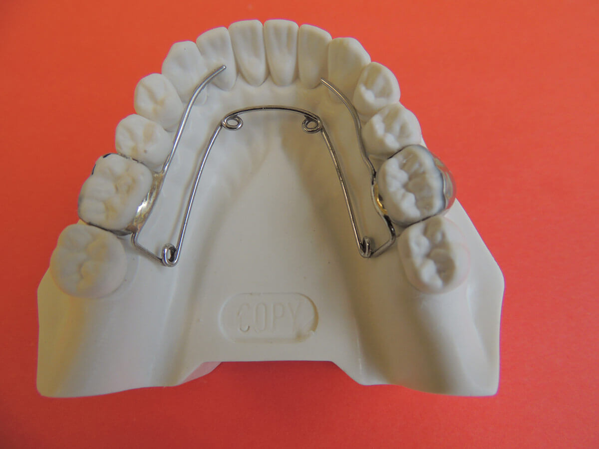 Aparatología Fija | Laboratorios de Ortodoncia Tecnodent
